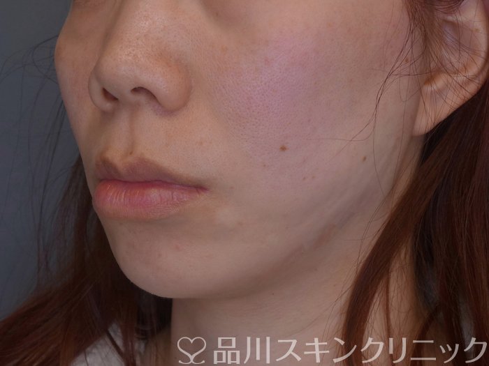 症例NO.74578のAFTER写真