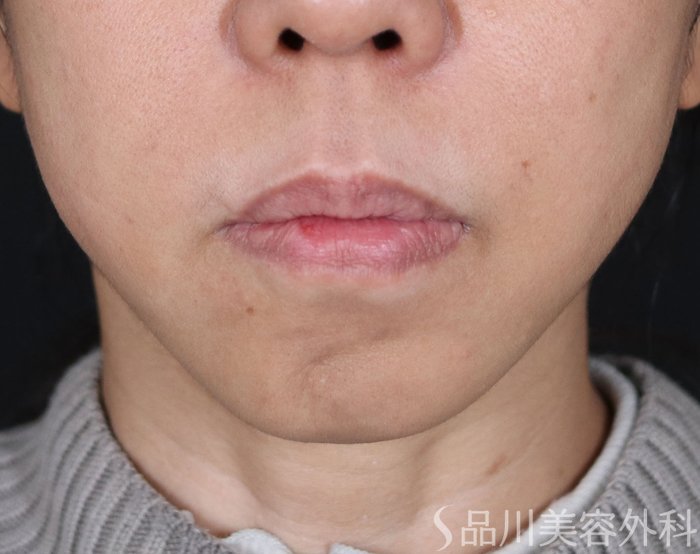 症例NO.71907のBEFORE写真