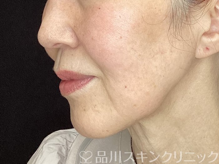 症例NO.72497のBEFORE写真