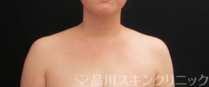 症例NO.74935のAFTER写真