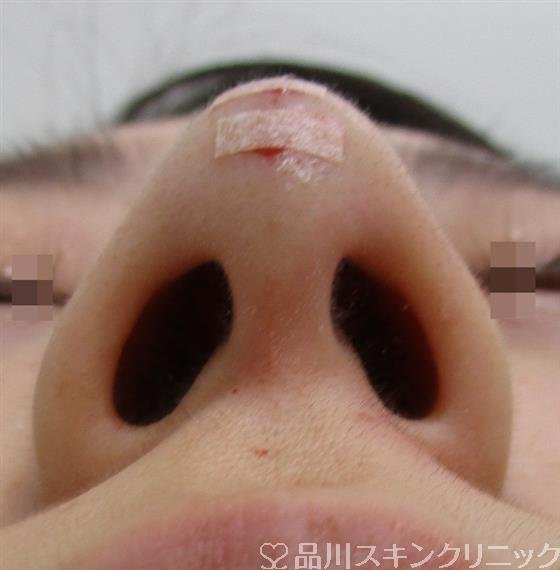 症例NO.43012のAFTER写真