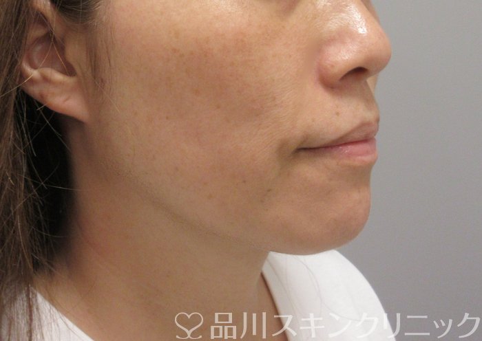 症例NO.71729のAFTER写真