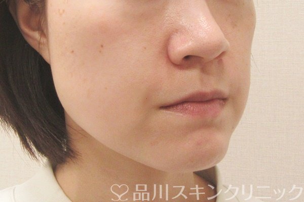 症例NO.69276のAFTER写真