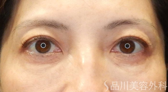 症例NO.69496のBEFORE写真