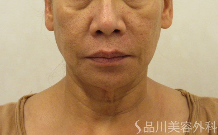 症例NO.71918のBEFORE写真