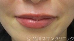 症例NO.69073のAFTER写真