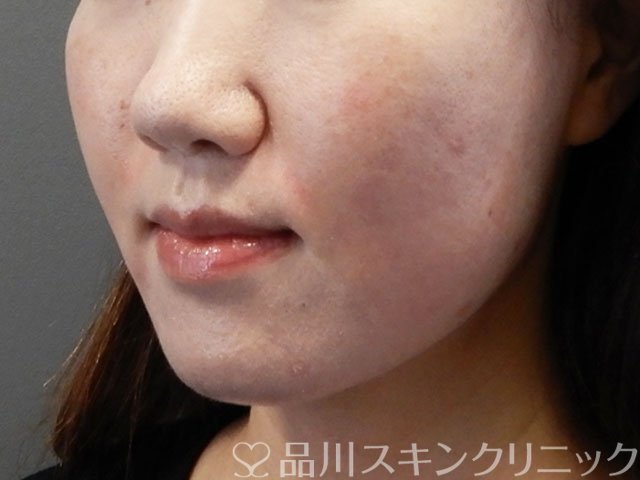 症例NO.71600のAFTER写真
