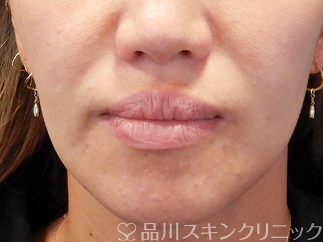 症例NO.71241のBEFORE写真