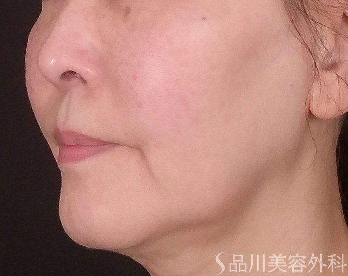 症例NO.69453のBEFORE写真