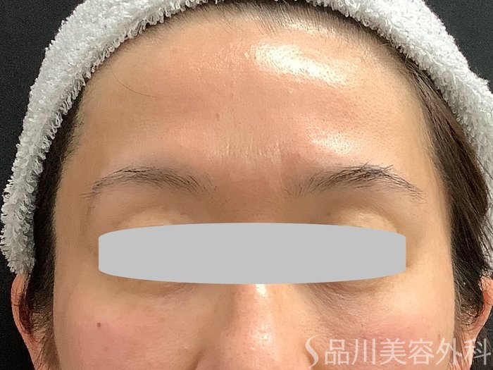 症例NO.67761のBEFORE写真
