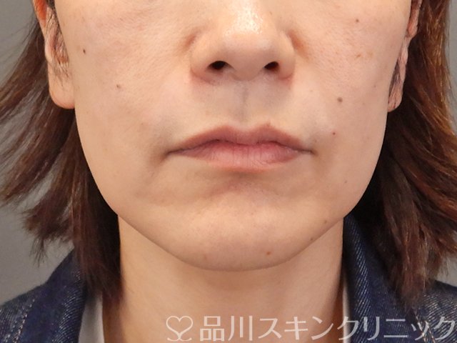 症例NO.75087のAFTER写真