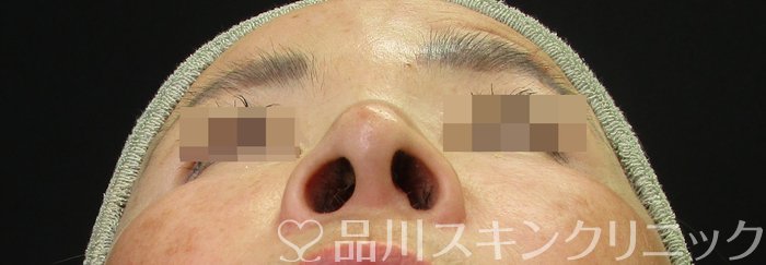 症例NO.73932のAFTER写真
