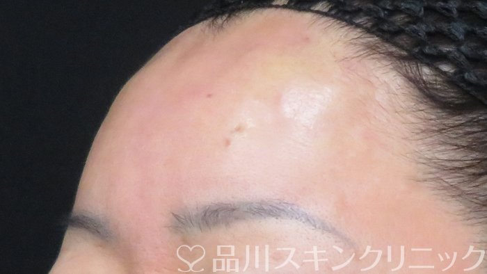 症例NO.71367のAFTER写真