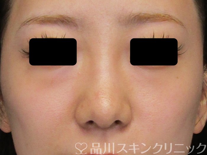 症例NO.74691のBEFORE写真