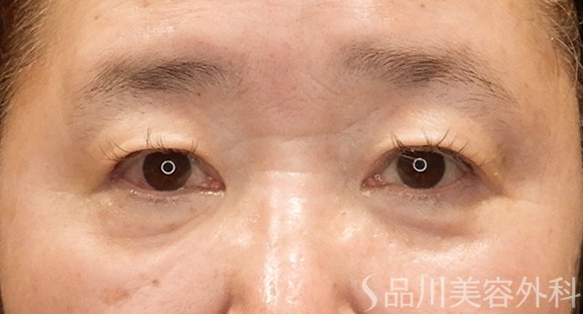 症例NO.75353のBEFORE写真