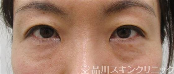 症例NO.52427のBEFORE写真