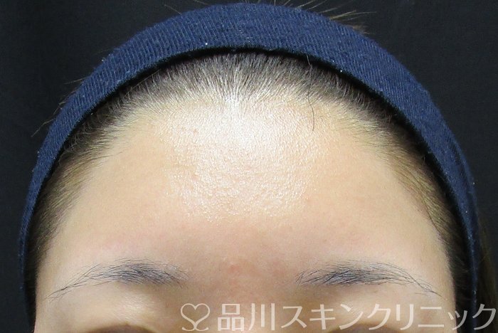 症例NO.65015のAFTER写真