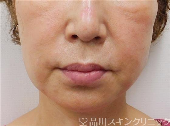 症例NO.56338のAFTER写真