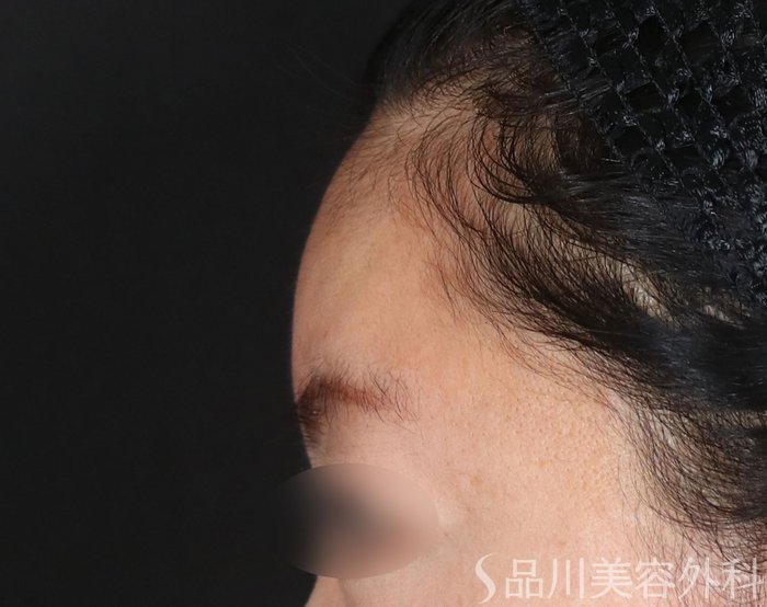 症例NO.74153のBEFORE写真