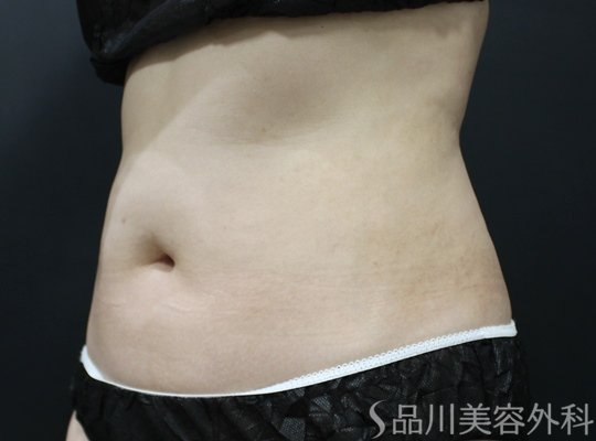 症例NO.75315のBEFORE写真