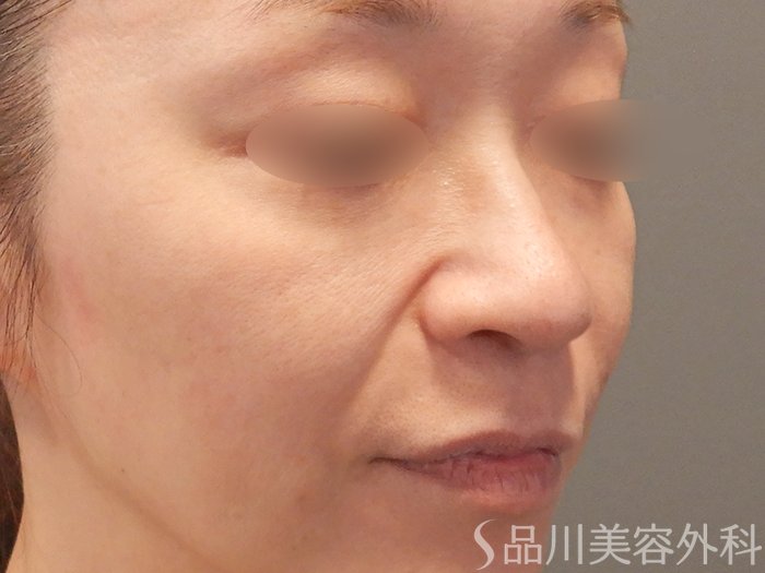 症例NO.70922のBEFORE写真