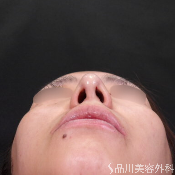 症例NO.71212のAFTER写真