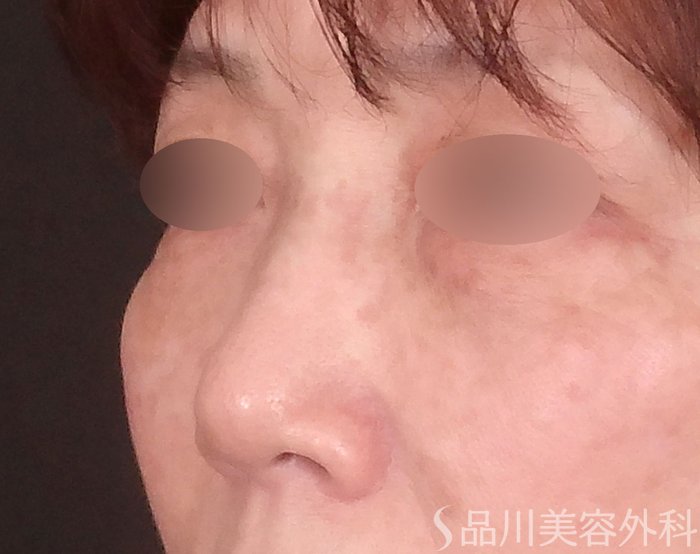 症例NO.71415のBEFORE写真