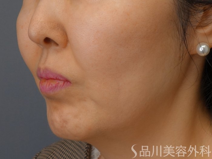 症例NO.73688のBEFORE写真