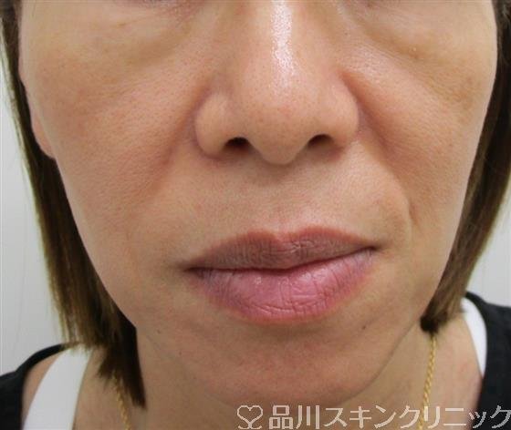 症例NO.42919のBEFORE写真