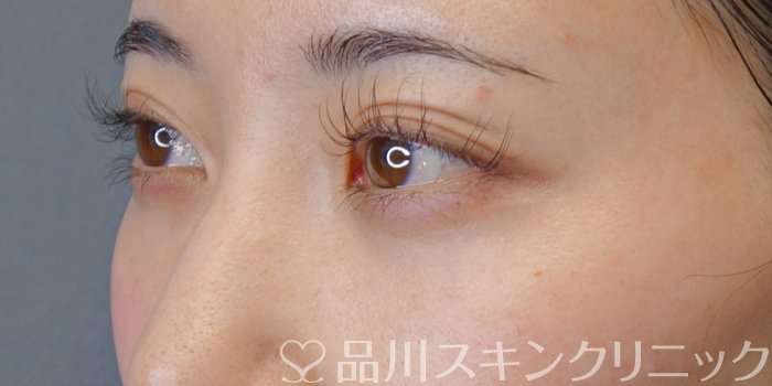 症例NO.74112のAFTER写真