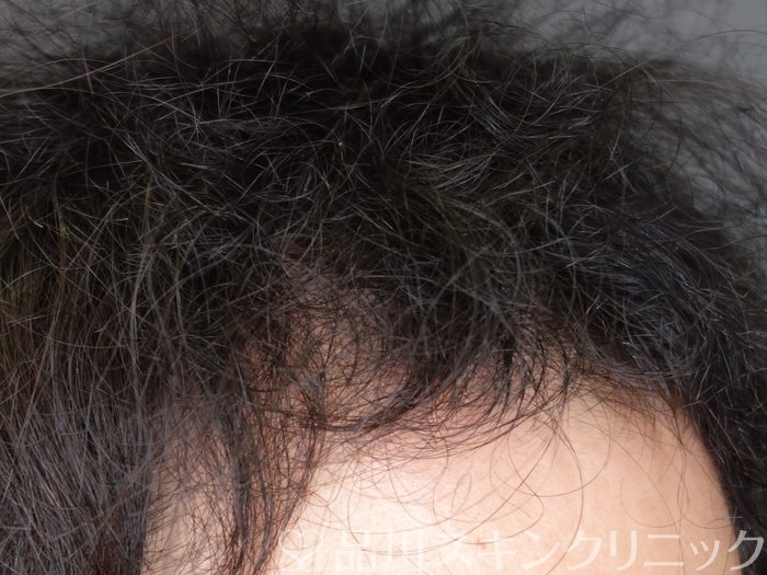 症例NO.73493のAFTER写真