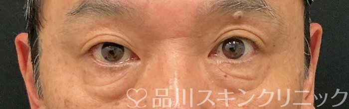 症例NO.74845のBEFORE写真
