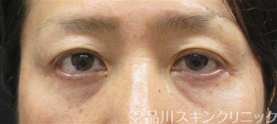 症例NO.60358のAFTER写真