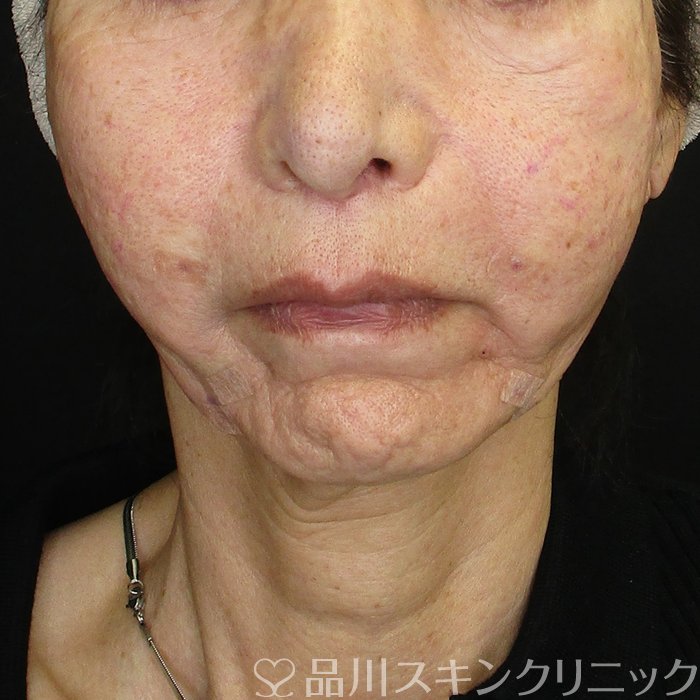 症例NO.75054のAFTER写真