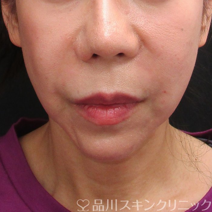 症例NO.72773のAFTER写真