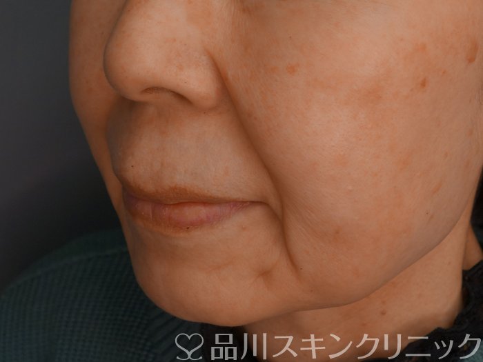 症例NO.75320のBEFORE写真