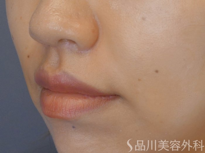症例NO.69895のAFTER写真