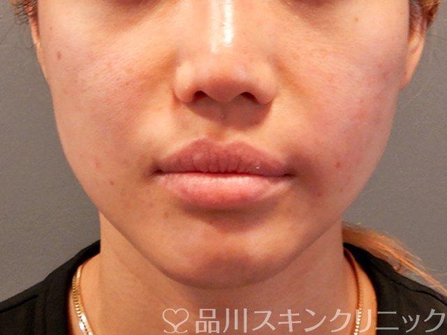 症例NO.70029のAFTER写真