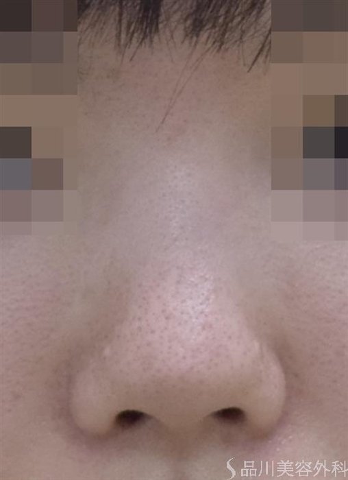症例NO.52913のBEFORE写真