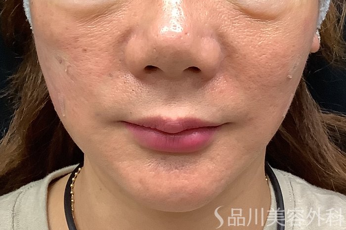症例NO.67810のAFTER写真