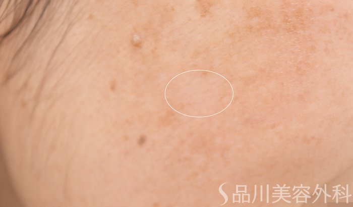 症例NO.64702のAFTER写真