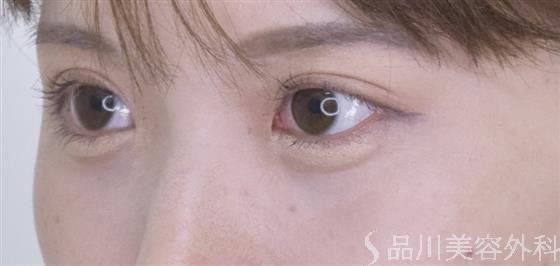 症例NO.52585のAFTER写真