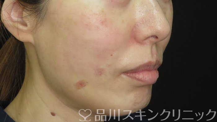 症例NO.71310のAFTER写真