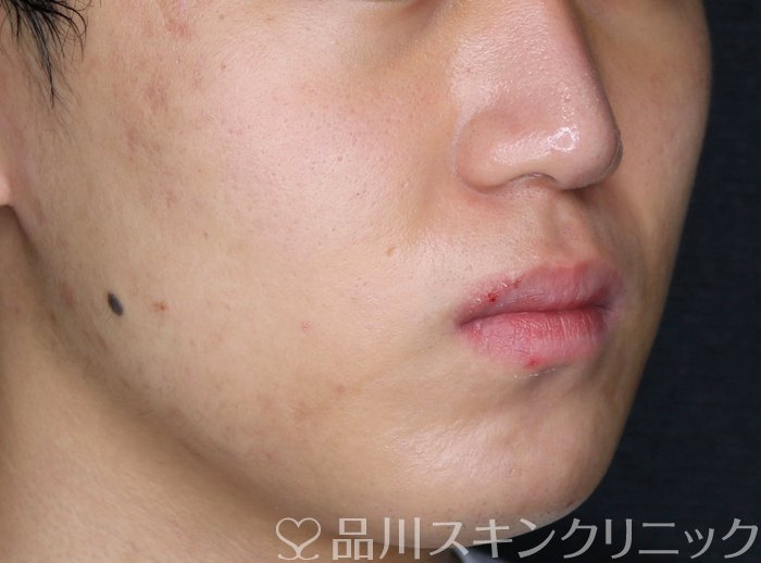 症例NO.74038のAFTER写真
