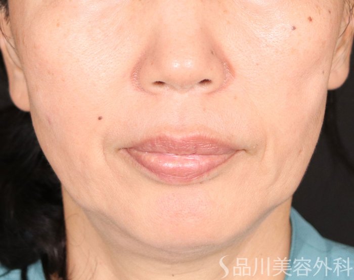 症例NO.70918のBEFORE写真