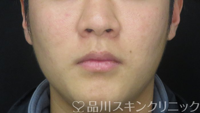症例NO.70863のAFTER写真