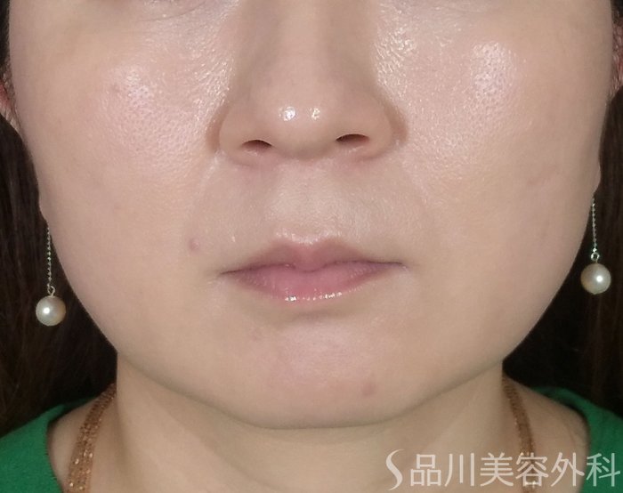 症例NO.64636のBEFORE写真
