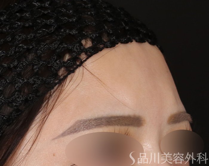 症例NO.71951のBEFORE写真