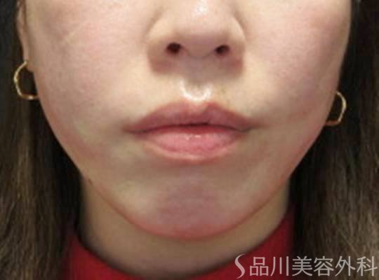 症例NO.73564のAFTER写真