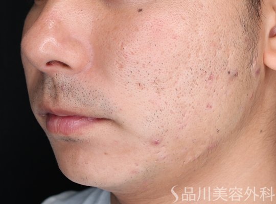 症例NO.72445のAFTER写真